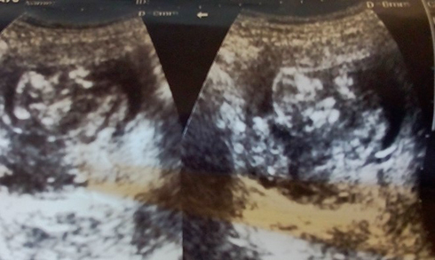Figure 1 Trans-abdominal sonography showed non-alive fetus with gestational age of 12 weeks by crown rump length.