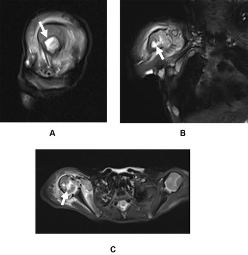 Figure 1 MRI showing bone marrow edema (white arrow) in the right shoulder in the (A) sagittal view, (B) coronal view, and (C) axial view.
