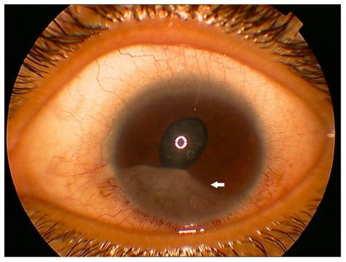 Figure 2 Enlargement and heavy vascularization of one of the treated pearl-like lesions (arrow) six weeks after treatment by subconjunctival and topical steroids.