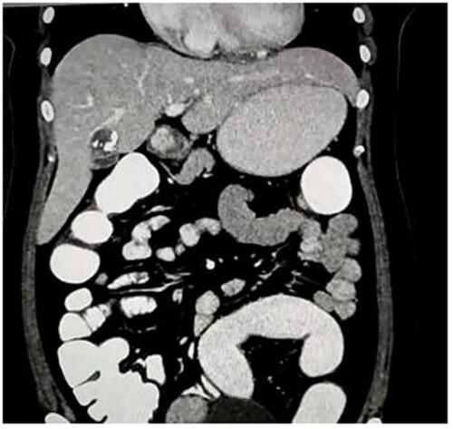 Figure 2 Computed tomography (CT) scan showing well-defined cystic lesion with internal septations and septal and peripheral calcification in segments IVa/IVb of the liver.