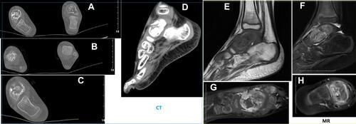 Figure 2 Representative imaging results of case 2 in Table 1. (A–C) CT scans showing significant bone destruction, and intramedullary neoplasm. The white arrow showing bone destruction and intramedullary masses. (D–H) Simultaneous magnetic resonance images showing serious bone destruction and soft tissue swelling. The white arrow showing obvious bone destruction and soft tissue swelling.