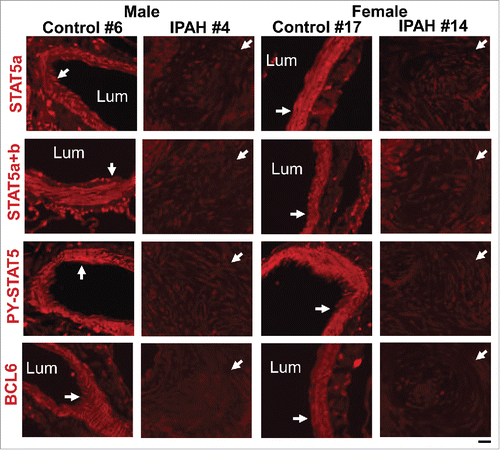 FIGURE 8. Representative immunofluorescence images showing coordinate reductions in STAT5a/b, PY-STAT5 and BCL6 in obliterative pulmonary arterial lesions in male and female patients with late-stage IPAH compared to control arterial walls (white arrows). The patient numbers correspond to the listing in Supplemental Table 2 in ref. Citation83. Scale bar = 50 µm.