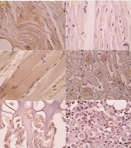 Figure 3 a1) Tissue-type plasminogen activator (tPa)-positive myocardium treated with ultrasound microbubbles (immunohistochemical stain 200×). a2) tPa-negative myocardium treated without ultrasound microbubbles (immunohistochemical stain 200×). b) tPa-positive skeleton muscles after transfection (immunohistochemical stain 200×) c) tPa-positive liver cells after transfection (immunohistochemical stain 400×). d) tPa-positive chondrocytes in the cartilage germinal layer after transfection (immunohistochemical stain 400×). e) tPa-positive myeloid cells and interstitial cells in medulla ossium after transfection (immunohistochemical stain 400×).