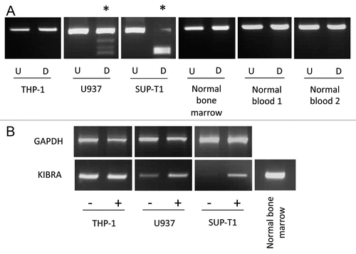 Figure 1 Leukemia cell line methylation and expression status. KIBRA methylation and re-expression in leukemia cell lines. (A) Undigested PCR product (U) is shown next to digested PCR product (D) for three leukemia cell lines, one normal bone marrow sample and two normal blood samples. (B) GAPDH and KIBRA RT-PCR results are shown for unmethylated cell line THP-1, partially methylated cell line U937 and completely methylated cell line SUP-T1 pre (−) and post (+) treatment with 5-aza-2′-deoxycitidine. * indicates methylated samples.