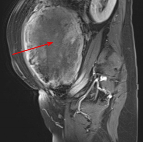Figure 8 Sagittal contrast-enhanced T1-weighted fat saturated image shows the presence of central non-enhancement (red arrow).