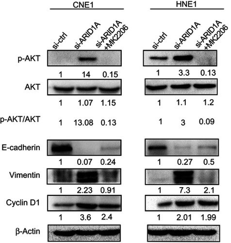 Figure 7 MK-2206 rescued the changes in Cyclin D1 and EMT-associated markers in ARID1A-silenced NPC cells. Western blot analysis of the expression of ARID1A, p-Akt, Akt, Cyclin D1, E-cadherin and Vimentin. MK-2206 rescued the changes in Cyclin D1, E-cadherin and Vimentin expression in ARID1A-silenced NPC cells.Abbreviations: NPC, nasopharyngeal carcinoma; ARID1A, AT-rich interacting domain-containing protein 1A.