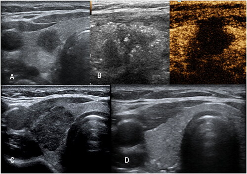 Figure 2. A case of RFA. (A) A 34-year-old female patient with a suspected lesion located in the right lobe of the thyroid, which was confirmed as PTMCs by FNAB; (B) After US-guided RFA, the ablated lesion was evaluated with CEUS;(C) In the 1st week follow up, the ablated lesion appeared as a well-defined heterogeneous echogenic area on the grayscale US; (D) On the final follow-up, the ablated area was almost completely absorbed.