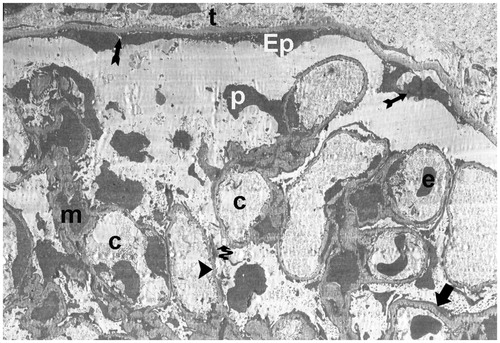 Figure 18. (Electron micrographs show ischemia–reperfusion group ultrastructure). Electron micrographs showing a glomerulosclerosis. Capillary basement membrane lamina densa, lamina rara interna and externa disappear (arrow head). Necrotic podocytes (p) and mesangial cell (m). Podocytes infolding (arrow). Necrotic paritel epithelial cell (Ep). Vacuoles in the cytoplasm of the parietal epithelial cells (tailed arrow). Small vacuoles in capillary basement membrane (spiral arrow). Capillary (c). Mesangial cell (m). Necrotic tubules (t). 15,000×.