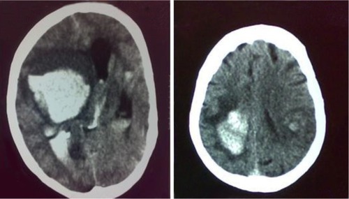 Figure 2 Posttreatment computed tomography scans of two patients with symptomatic intracranial hemorrhage.