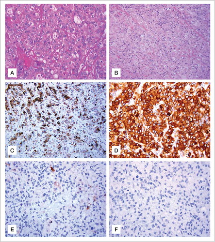 Figure 2. Hematoxylin and eosin stain gastric sections and immunohistochemical staining for Ck7, CEA, HER2 and E-cadherin. (A) Neoplastic cells showing diffuse solid growth and focal vague glandular appearances. H&E, original magnification 200x. (B) Signet-ring morphology of most neoplastic cells with infiltrative growth H&E, original magnification, 100x. (C) Ck7 immunopositive neoplastic cells, (IHC, Haematoxylin counterstain, original magnification 100x). (D) Strong cytoplasmic expression of CEA in neoplastic cells (IHC Haematoxylin counterstain, original magnification 200x). (E) Rare neoplastic Her 2 neu positive cells (IHC, Haematoxylin counterstain, original magnification 200x). (F) Absent expression of E cadherin in signet ring neoplastic cells (IHC, Haematoxylin counterstain, original magnification 200x).