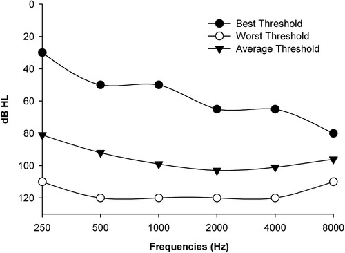 Figure 1 Best, worst and average acoustic hearing thresholds measured in the contra-lateral ear before cochlear implantation, as were available from patient charts of 92 CI participants.