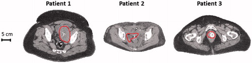 Figure 1. Transversal cross-sections of the CT scan for the three patients. The contour indicates the target region. Cross-sections are at the centre of the target region in axial direction.