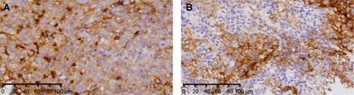Figure 1 Immunohistochemical staining for PD-L1 in patients with locoregionally advanced NPC.