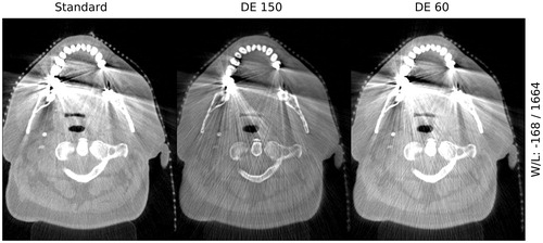 Figure 4. The impact of different reconstruction energies on metal artifacts and new artifacts in the DE images. The streaks in the DE images are seen to originate from the metal in the patient. Left: standard clinical CBCT. Middle: 150 keV DE CBCT. Right: 60 keV DE CBCT.