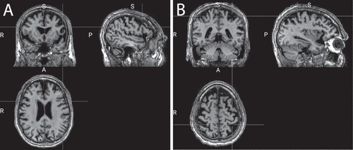 Figure 1. T1 MRI scan at the time of enrolment in the research. Panel A: MRI scan highlighting the frontal lobe; Panel B: Scan highlighting the parietal lobe. Significant atrophy in comparison to controls was restricted to the left frontal lobe.