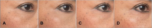 Figure 2 A 53-year-old female patient with a Merz Aesthetics Scale® score of 1 for infraorbital hollow at baseline (A) received supraperiosteal injections of 0.95 mL CPM® hyaluronic acid gel per side. Complete correction remained throughout the observation period at (B) 3 months, (C) 6 months, and (D) 9 months after treatment.® Dr. Huber-Vorländer.