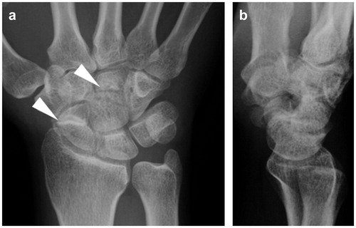 Figure 2. Radiographic assessment of the hand at our hospital. (a) Posteroanterior and (b) lateral plain radiographs showing scaphoid non-union and a radiolucent line in the central area of the capitate.