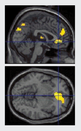 Figure 2. Brain responses during the affective Go-No Go task in patients with mania and healthy controls. This section shows areas of increased activity in patients relative to controls, in blocks when positive (happy) words were distracters compared with blocks where neutral valenced words were distracters, consistent with increased brain activity to mood-congruent, task-irrelevant information. Reproduced from ref 70: Elliott R, Ogilvie A, Rubinsztein JS, Calderon G, Dolan RJ, Sahakian BJ. Abnormal ventral frontal response during performance of an affective go/no go task in patients with mania. Biol Psychiatry. 2004;55:1 163-1 170. Copyright © Elsevier 2004