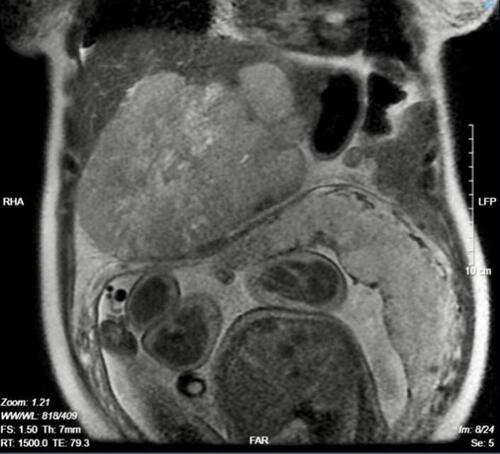 Figure 1 Liver tumor on T2.
