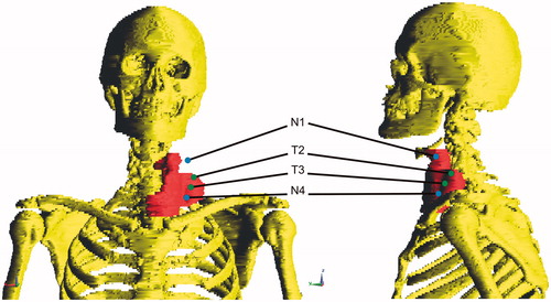 Figure 4. [Case 1] Frontal and sagittal view of the patient. For clarity, only segmented bone and CTV are shown. Blue probes (N1,N4) are probes outside the CTV, green probes (T2,T3) are within the CTV and are used to partly base our steering actions on.