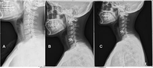 Figure 3 Typical case in the Prodisc-C Vivo group. The patient was diagnosed with cervical spondylosis. (A–C) Anterolateral view of the cervical spine preoperatively, postoperatively, and at the last follow-up. While there was no significant change in the sagittal balance of the cervical spine between before and after the operation, the neurological symptoms and pain were mitigated postoperatively.