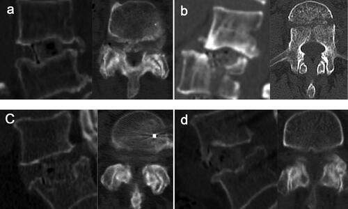 Figure 5. (a)–(d) Severe endplate damage or even coronal vertebral fractures accompanied by facet joint degeneration.