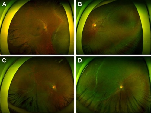 Figure 8 Cases that are good candidates for scleral buckling.