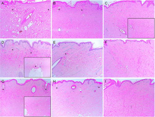 Figure 3 Immediate tissue reactions in in vivo minipig skin after RF treatment without PCC. The skin of minipig was treated with RF at the frequencies of (A-C) 0.5 MHz, (D-F) 1 MHz, and (G-I) 2 MHz and the total treatment time and number of sub-pulse packs of (A, D, G) 500 ms and single pulse pack, (B, E, H) 1000 ms and six sub-pulse packs, and (C, F, I) 5000 ms and 10 sub-pulse packs. Inlet, histological photographs showing the mid and deep dermis. Asterisks, peri-electrode coagulative necrosis zones. Hematoxylin and eosin staining. Original magnification × 40.