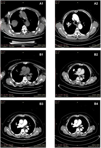 Figure 1 CT scan images of typical patients in group A.(A1, A2) CT scan of a 82-year-old male patient with Squamous cell carcinoma. (A1) The pre-treatment CT image shows a mass in the right upper lobe (September 19, 2016). (A2) The target lesion significantly decreased in size after the combination of iodine-125 seed implantation and single-agent chemotherapy regimen. The chest pain symptoms were relieved considerably (March 15, 2017). (B1–B4). CT scan of a 64-year-old female patient with adenocarcinoma. (B1) The pre-treatment CT image shows a lesion in middle lobe of right lung (March 10, 2016). (B2) Five months after treatment, the CT scan indicated a complete response (October 23, 2016). (B3, B4) After continuous follow-up, the lesion disappeared and remained in a slight high-density area in the middle lobe of the right lung (April 29, 2020).
