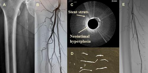 Figure 2 (A) Preoperative radiography showing the stent position; (B) intraoperative angiography; (C) during OCT-guided atherectomy; (D) neo-intimal hyperplasia/plaque material was removed; (E) angiogram after completion.