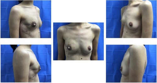Figure 3 Right breast cancer with nipple-sparing mastectomy and tissue expander reconstruction.