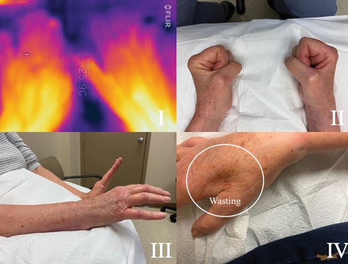 Figure 1. (a) A 64-year-old female presented two months after ORIF for a distal right radial and ulnar fracture. There is involvement of the wrist and all fingers. I. FLIR ONE imagery of the dorsal aspect of each hand shows temperature asymmetry. The affected side is notably warmer than the unaffected. A II,III, IV show the reduced range of motion and swelling of the joints. (b) After three weeks on prednisone. The temperature on FLIR imaging (1BI) , swelling and range of motion (1B II III) have improved. The wasting of the first dorsal interossei (FDI) (1B IV) and weak intrinsic muscles is now apparent. Nerve conductions reveal the ulnar nerve has a small amplitude of 3mV, with no slowing at the elbow. The ulnar sensory was normal. The EMG to the FDI showed florid denervation, with no motor units recruiting. The adductor digiti minimi had 2+ denervation with reduced polyphasic recruitment, while the flexor carpi ulnaris was normal. Ulnar nerve entrapment at the wrist was diagnosed. Ulnar nerve decompression was performed at the wrist. Full resolution of all symptoms was achieved.