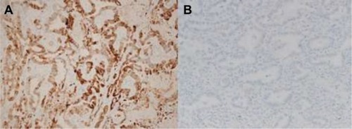 Figure 1 Representative sections of lung adenocarcinoma tissues with cytoplasmic staining for Cox-2. (A) High expression; (B) low expression.