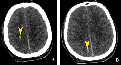 Figure 9 Axial NECT in a 15 years old male patient pedestrian hit by a fast-moving vehicle. Right parieto-occipital diffuse axonal injuries. (A) Axial NECT brain window shows round hyperdense focus in the right parietal white matter (yellow pointed arrow). (B) Axial NECT brain window shows the same type of lesion in the right occipital white matter (yellow pointed arrow).