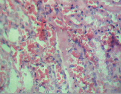 Figure 2. Extensive intertubular hemorrhage (H&E staining, × 280).