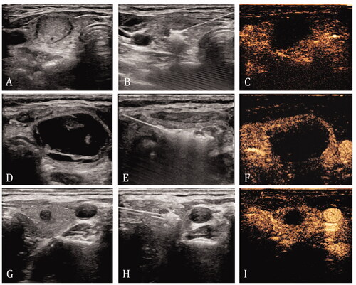 Figure 1. Ablation methods for different nodules. (A–C) Nodules that were completely solid or mixed with 90% solid components were directly ablated. The ablation target is the entire nodule. (D–F) For nodules with more than 50% fluid content, the fluid was withdrawn first, followed by saline flushing and ablation. The ablation target is the entire nodule. (G–I) Malignant nodules are ablated directly, and the target for ablation was the entire tumor and the area at least 2 mm from the original tumor margin.