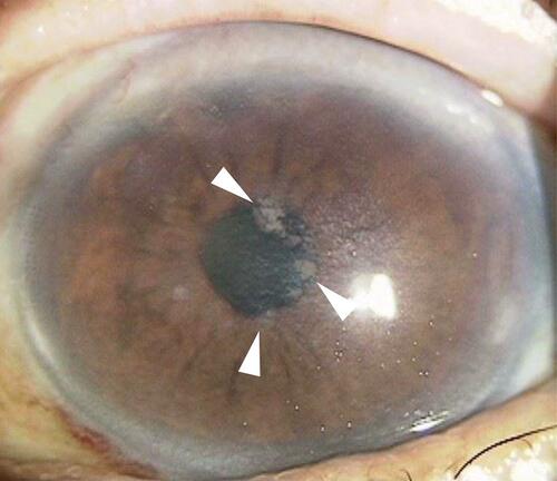 Figure 1 Photograph of the anterior surface of the cornea of a 75-year-old man. A grayish-white epithelial opacity can be seen on the central cornea.