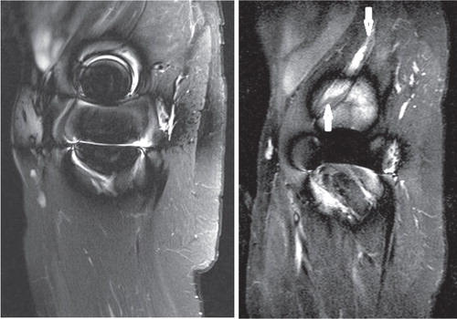 Figure 4. Man aged 41 at the time of the index operation for ASR HR. Time to first MRI (left) was 7.7 years. The time elapsed between imagings was 18 months. Both times, whole-blood Co and Cr remained below 4 ppb. MRI was repeated as a control imaging in the annual follow-up visit due to joint effusion seen in the first scan. However, development of a type-2A pseudotumor was seen.