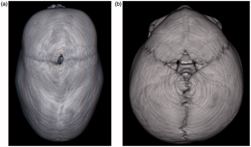 Figure 1. Sagittal and metopic suture synostosis results in different skull shapes shown on a CT-scan before operation. (a) Sagittal suture synostosis, resulting in the typical boat-like shaped skull, scaphocephaly. (b) Metopic suture synostosis, resulting in trigonocephaly.