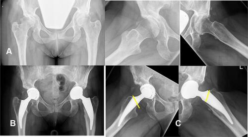 Figure 5 42-year old woman with dysplasia coxartrosis following Salter procedure and derotation osteotomy in childhood (A). Leg length and offset could be successfully reconstructed with the short stem (B). The increased anteversion was corrected by a slight posterior tilt of the osteotomy (yellow line) (C).