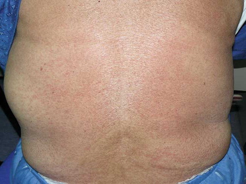 FIGURE 1. Pruritic erythematous skin lesions on the back as part of widespread dermatitis of the patient at the day of admission to our department.