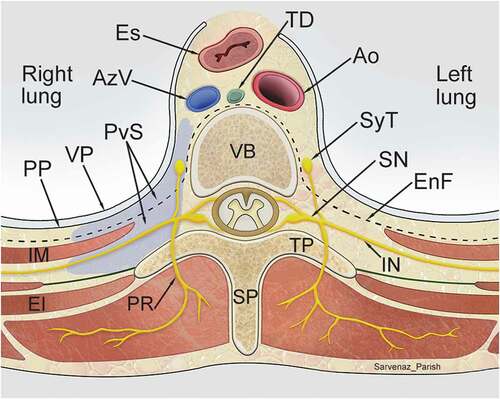 Figure 1. Transverse section showing extent and spatial relationships of the thoracic paravertebral space (purple) to surrounding structures. Nerves traversing through the paravertebral space, including the intercostal nerves and the sympathetic trunk, are targeted with paravertebral block. Ao, Aorta; AzV, Azygos vein; EI, External intercostal muscle; EnF, Endothoracic fascia; Es, Esophagus; IM, Innermost intercostal muscle; IN, Intercostal nerve; PP, Parietal pleura; PR, Posterior ramus; PvS, Paravertebral space; SN, Spinal nerve; SP, Spinous process; SyT, Sympathetic trunk; TD, Thoracic duct; TP, Transverse process; VP, Visceral pleura. (Illustration credit: Dr. Sarvenaz Parish)