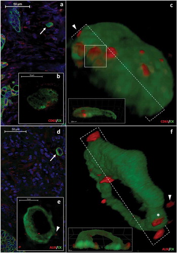 Figure 1. CD63 and ALIX positive protrusions in the cytoplasmic border of migrating colorectal cancer cells (a-b) show the same cytokeratin (CK, green) positive migrating CRC cell. (b) shows granular CD63 (red) protein expression in the cortical cytoplasm. Scale bars: 50 μm (a) and 10 μm (b). (c) 3D reconstruction of the same cell as in (a) and (b). CD63 positive structures are present either partially outside of the cytoplasm (arrowhead) or covered with a thin CK positive layer (white box). (d and e) ALIX (red)/CK (green) co-immunostaining in another migrating CRC cell. Scale bars: 50 μm (d) and 10 μm (e). (f) shows a 3D reconstruction of the cell same as in Figure 1(d) and 1(e) with ALIX positive structures (red) which are partially (asterisk) or completely (arrowhead) outside of CK positive cytoplasm.