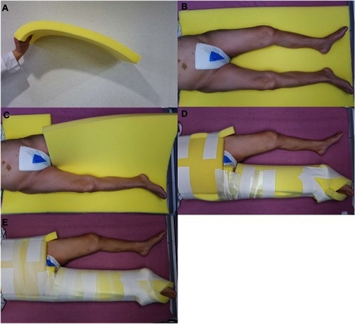 Figure 1 (A) The sponge has a multi-pore structure; thus, it is light, easily ventilated, and can be passively deformed but has the strength to resist gravitational forces. (B) The patient was placed in a supine position on the sponge. The length of the sponge ranged from the big toe to the iliac wing if the femur was fractured. (C) The sponge was cut to allow the broken limb to be wrapped circularly. (D) The sponge cast was fixed with multiple bandages. (E) The adhesive elastic bandage was wrapped circularly and fixed.