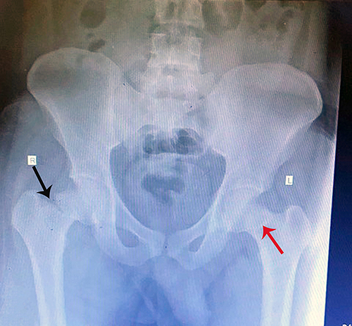 Figure 1 Antero-posterior (AP) radiograph showing the right neck of the femur with an intracapsular displaced fracture (black arrow). On the left side, the x-ray shows an occult fracture in the neck of the femur (red arrow).