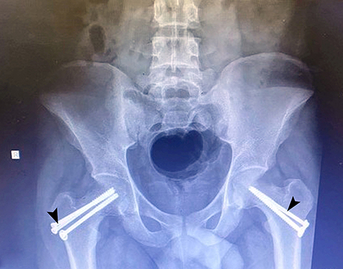 Figure 4 An anteroposterior radiograph of the 7.0 mm cannulated screws (arrowheads) implanted bilaterally to the neck femur on both the right and left sides of the body.