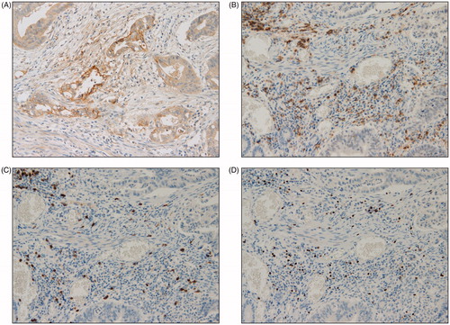Figure 2. Representative examples of immunohistochemical findings of intraepithelial infiltrating lymphocytes. Microsatellite stable PD-L1 expression (A) CD4+ T cells (B), CD8+ T cells (C), FOXP3+ T cells (D) (magnification × 400).