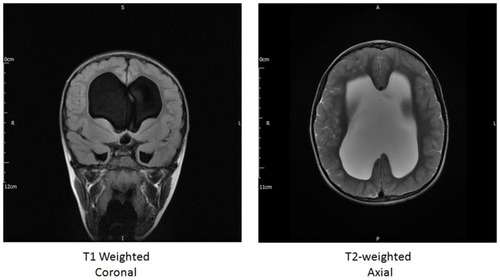 Figure 2 Eight-year-old ♀, presenting with macrocephaly and congenital visual loss. She also has a history of hypopituitarism, on replacement medications. Examination showed stable signs of likely “burnt out” or stable hydrocephalus. Images confirm absent chiasm, and monoventricle resulting from absence of septum pellucidum as seen in many patients with SOD.