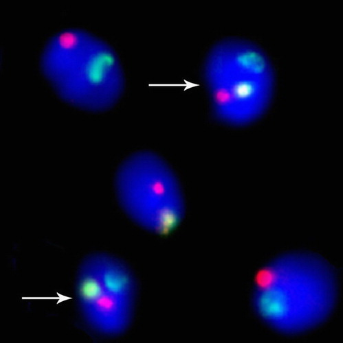 Figure 2.  Fluorescent in-situ hybridization (FISH) on decondensed human spermatozoa for chromosomes 21 (red), X (yellow), and Y (green). In this field of view there are five spermatozoa, three are normal for the chromosomes tested (two Y bearing sperm and one X bearing sperm). The remaining two spermatozoa (indicated by arrows) are XY disomic sperm; if one of these spermatozoa had successfully fertilized an oocyte it would have resulted in a Klinefelter conceptus (47,XXY).