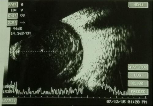 Figure 1 Diffuse vitreous opacity at the time of admission.